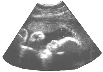 Johnny in the womb